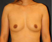 Feel Beautiful - Breast Augmentation 159 - Before Photo